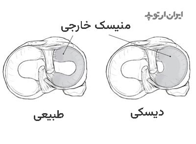 منیسک دیسکوئید