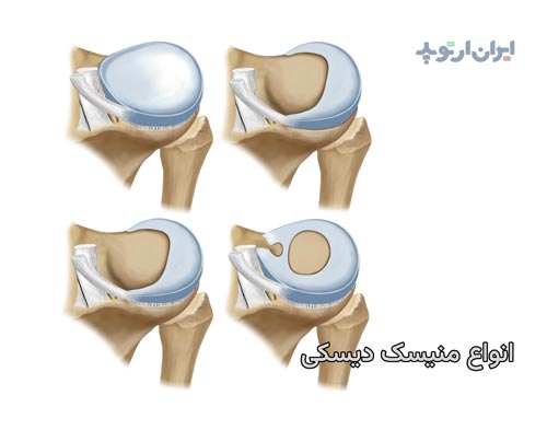 انواع منیسک دیسکی شکل