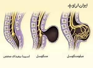 انواع اسپینا بیفیدا شامل مننگوسل و میلومننگوسل