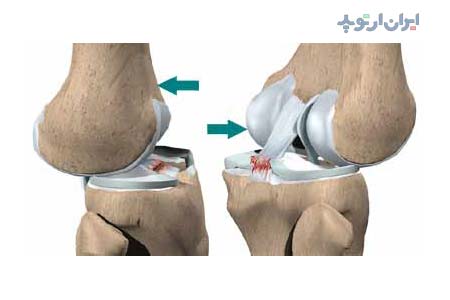 آناتومی زانو. پارگی رباط صلیبی