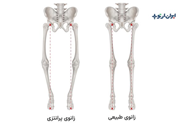 پای پرانتزی