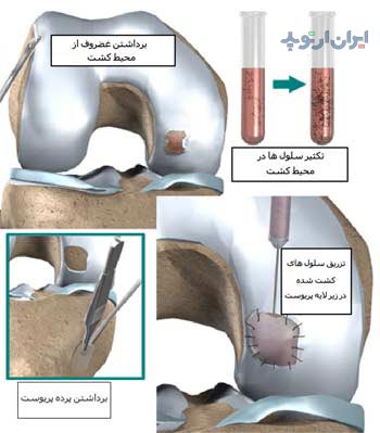 کشت غضروف در درمان آسیب های غضروف زانو