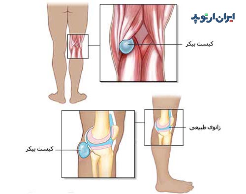 کیست بیکر زانو