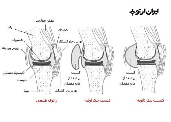 کیست پشت زانو یا کیست بیکر چیست