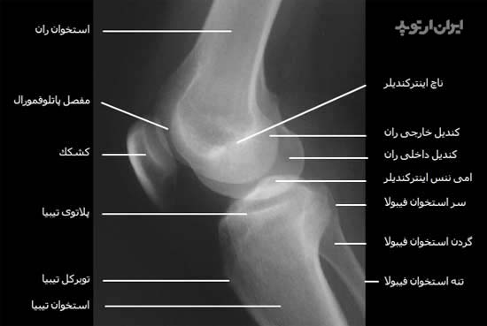 رادیوگرافی نیمرخ مفصل رانو