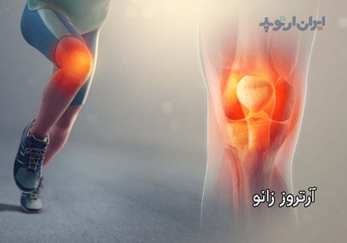 آرتروز زانو چه علائمی دارد و درمان آن چیست