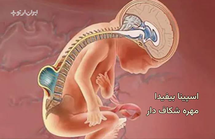 اسپینا بیفیدا یا مهره شکاف دار