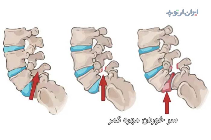 سر خوردن مهره کمر