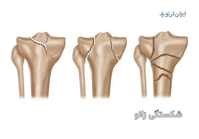 شکستگی زانو چگونه درمان میشود