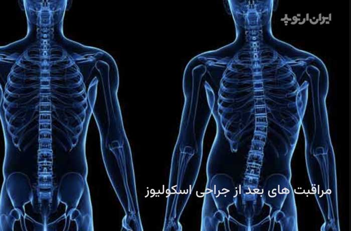 مراقبت بعد از جراحی اسکولیوز