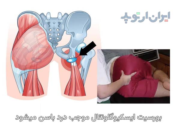 بورسیت ایسکیوگلوتئال و درد باسن