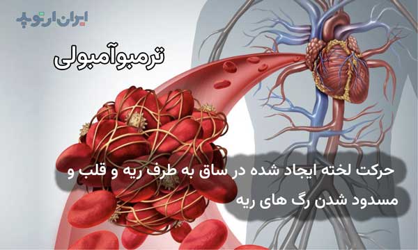 ترومبوآمبولی به معنای حرکت لخته ایجاد شده در ساق به سمت ریه و قلب و انسداد عروق ریوی است