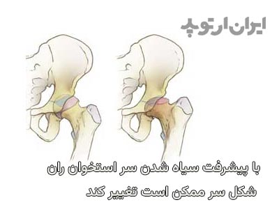  تغییر شکل سر استخوان ران بدنبال نکروز