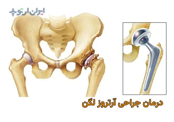 درمان های جراحی آرتروز و ساییدگی لگن و مفصل ران چیست