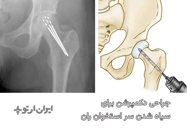 جراحی دکمپرشن برای سیاه شدن سر استخوان ران