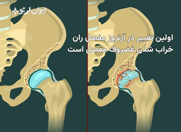 اولین تغییر در ساییدگی مفصل ران خرابی غضروف است