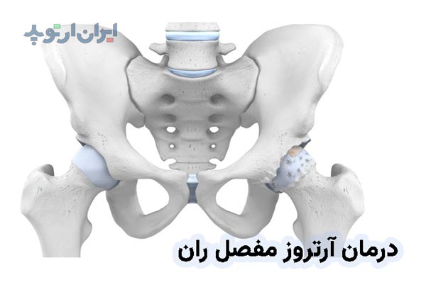 روش های درمان آرتروز و ساییدگی لگن و مفصل ران چیست