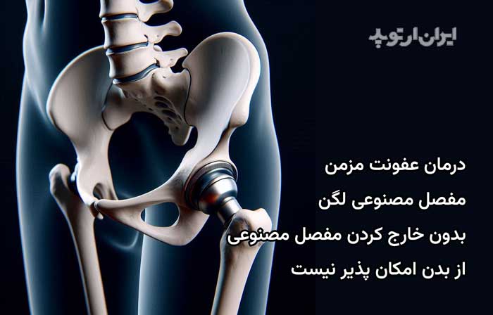 درمان عفونت مزمن پروتز کار گذاشته شده در لگن همیشه شامل خارج کردن پروتز است