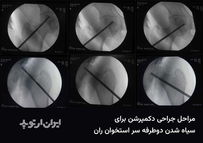 سوراخ کردن سر استخوان ران چپ و راست در چند ناحیه – تصاویر فوق از مانیتور دستگاه سی آرم و در حین عمل جراحی تهیه شده اند