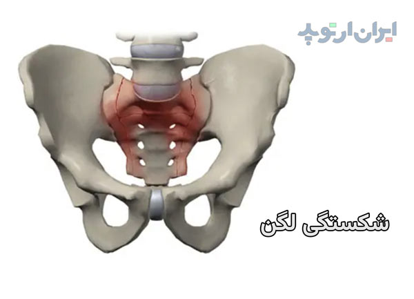 شکستگی در ناحیه لگن