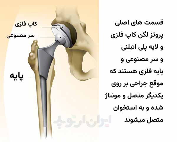 جراحی تعویض مفصل لگن میتواند درد لگن ناشی از خرابی شدید آن را از بین ببرد