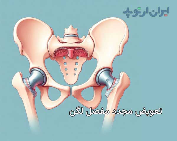 تعویض مجدد مفصل در ناحیه لگن