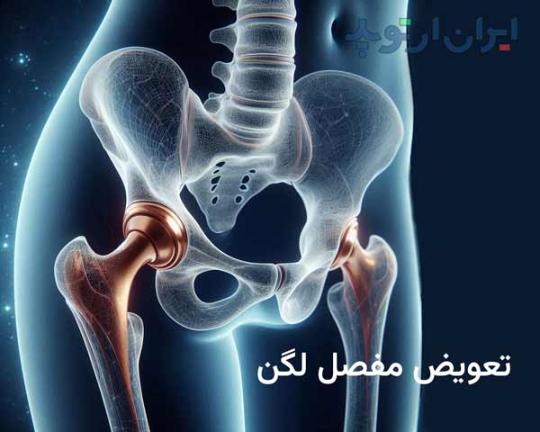 جراحی تعویض مفصل لگن چیست و چه فوایدی داد و چه کسانی به آن نیاز دارند