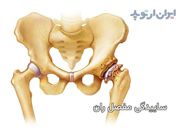 آرتروز و ساییدگی در مفصل ران چیست و چگونه درمان میشود