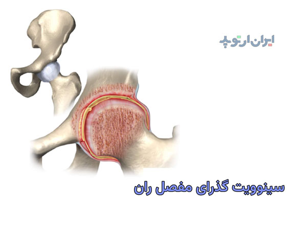 سینوویت گذرای مفصل ران