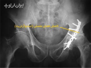 آرتروز و ساییدگی بعد از شکستگی استابولوم