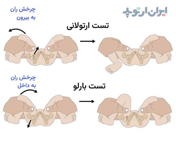 تست ارتولانی و بارلو برای تشخیص دررفتگی مادرزادی لگن و مفصل ران در نوزادان