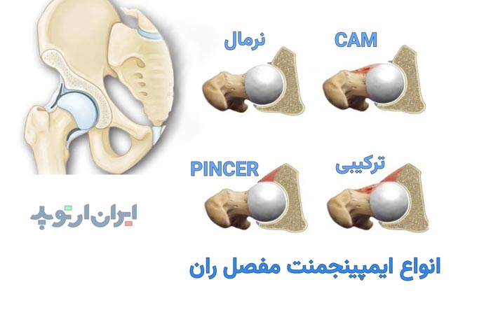 انواع ایمپینجمنت یا گیر کردن مفصل ران در لگن