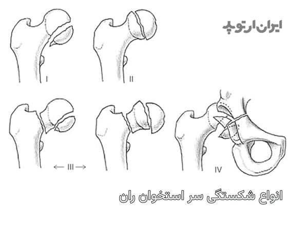 انواع شکستگی سر استخوان ران یا پیپکینز