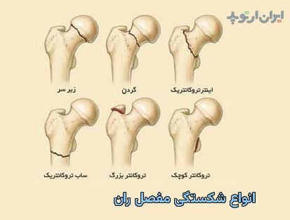 تقسیم بندی شکستگی مفصل ران