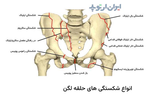 انواع شکستگی حلقه لگن