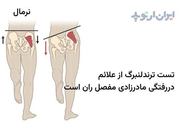  تست ترندلنبرگ در دررفتگی مادرزادی لگن و مفصل ران