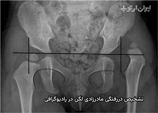 کمک رادیوگرافی به تشخیص دررفتگی مادرزادی لگن و مفصل ران در کودکان