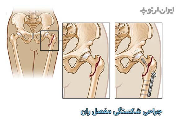 جراحی شکستگی مفصل ران