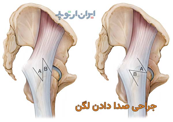 جراحی برای درمان صدای لگن