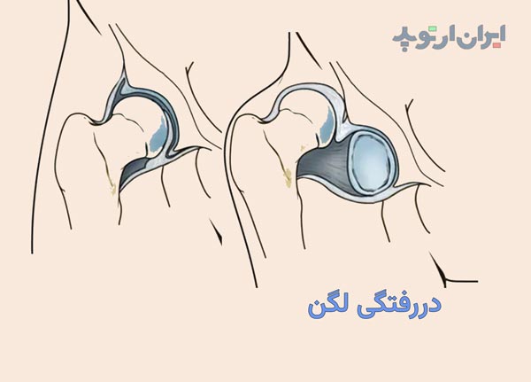 دررفتگی لگن چیست و چگونه درمان میشود