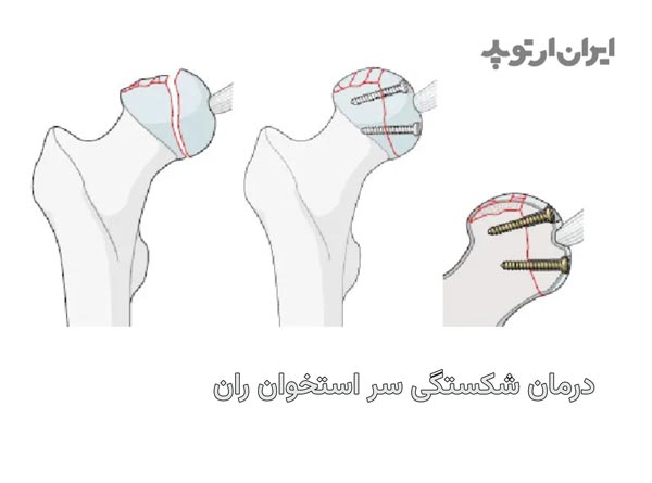 درمان شکستگی سر استخوان ران یا پیپکینز