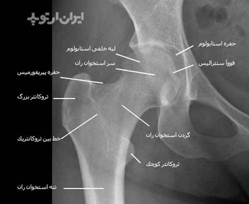  رادیوگرافی رخ مفصل ران یا هیپ