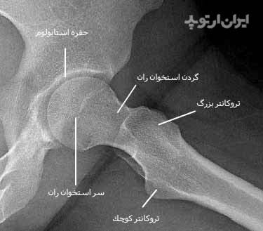 رادیوگرافی نیمرخ مفصل ران