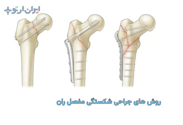 روش های جراحی شکستگی مفصل ران چیست