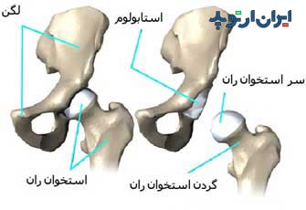 سر استخوان ران و حفره استابولوم در مفصل ران