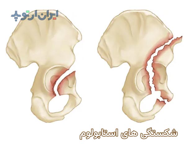 شکستگی های ناحیه استابولوم در لگن چه خصوصیاتی دارد