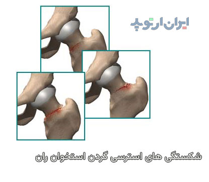  شکستگی استرسی گردن استخوان ران