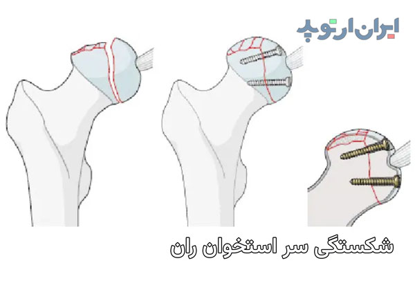 شکستگی های سر استخوان ران چه خصوصیاتی دارند