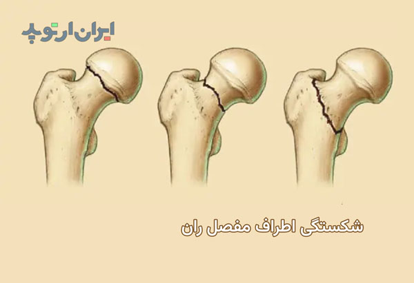 شکستگی های مفصل ران چه خصوصیاتی دارند