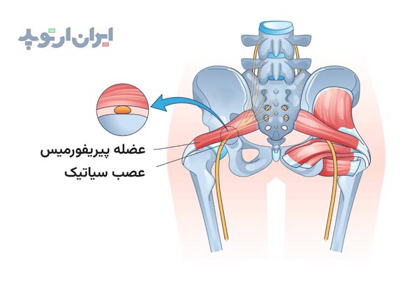 آناتومی عضله و سندروم پیریفورمیس